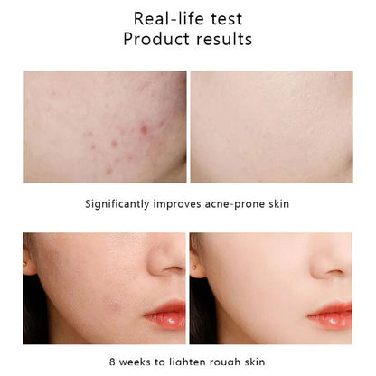 The Ordinary AHA 30% Exfoliating Fruit Acid Essence Remove Acne Mark Improve Dull Melanin Inhibition Brighten Anti-aging Care
